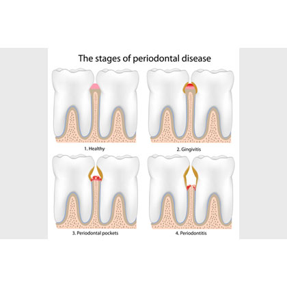 parodontaltherapie-zahnarzt